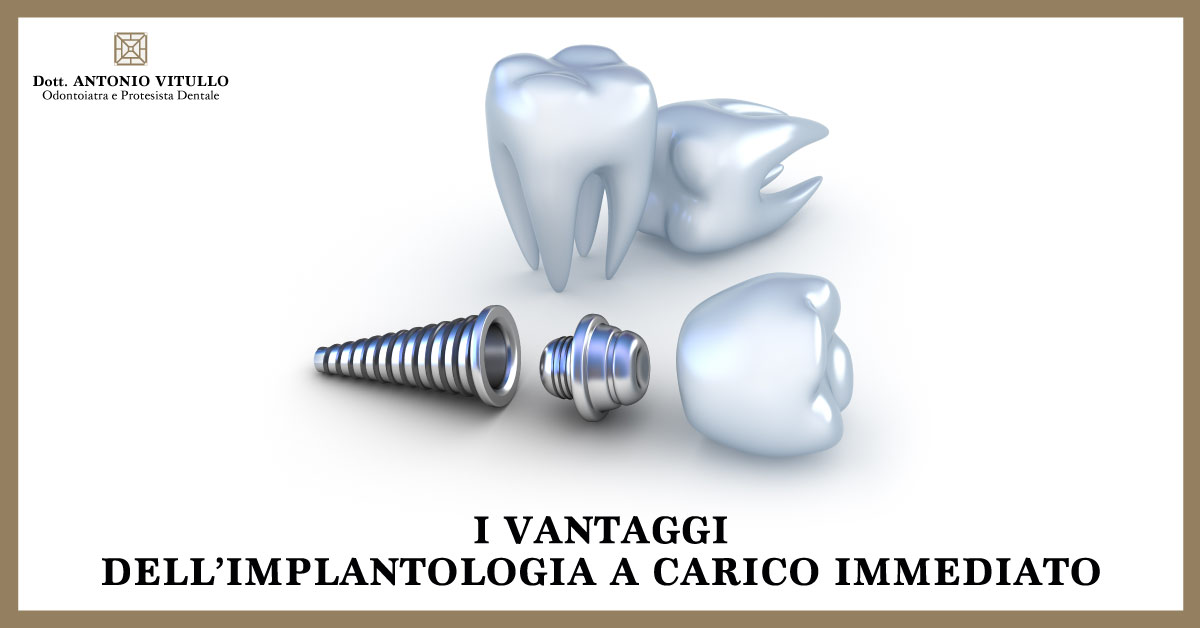 I vantaggi dell'implantologia a carico immediato | Studio Dentistico Vitullo | Dentista a Chieti